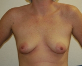Feel Beautiful - Breast Augmentation San Diego Case 55 - Before Photo